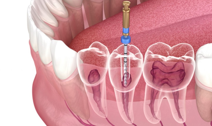 Răng đã điều trị tủy rất giòn và dễ vỡ
